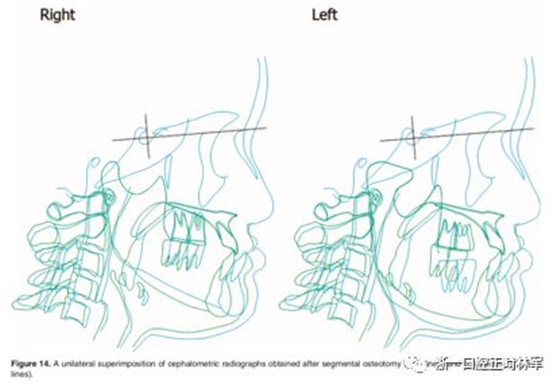 文献优秀正畸病例赏析-髁突增生性面部不对称的协同治疗1例