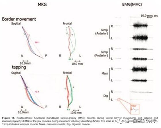 文献优秀正畸病例赏析-髁突增生性面部不对称的协同治疗1例