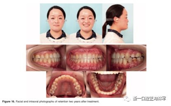 文献优秀正畸病例赏析-髁突增生性面部不对称的协同治疗1例