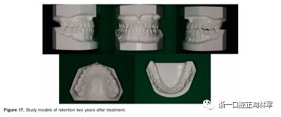 文献优秀正畸病例赏析-髁突增生性面部不对称的协同治疗1例