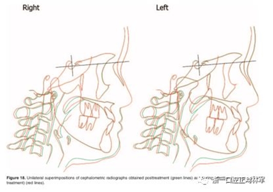 文献优秀正畸病例赏析-髁突增生性面部不对称的协同治疗1例