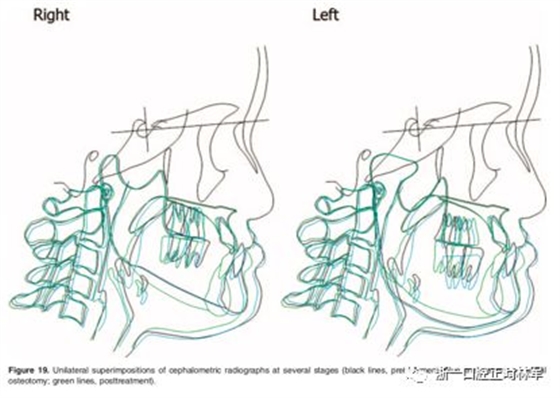 文献优秀正畸病例赏析-髁突增生性面部不对称的协同治疗1例