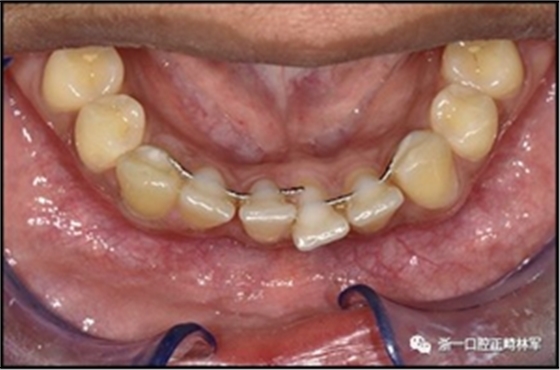 正畸文献阅读--固定舌侧保持器作用下意外的牙齿移动