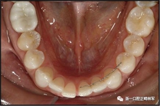 正畸文献阅读--固定舌侧保持器作用下意外的牙齿移动