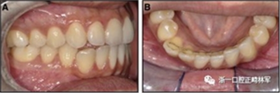正畸文献阅读--固定舌侧保持器作用下意外的牙齿移动