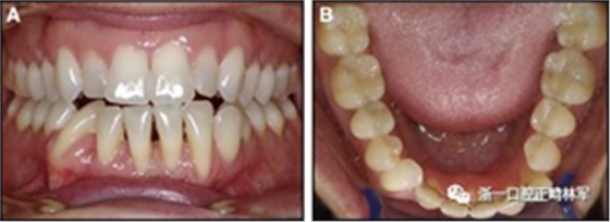 正畸文献阅读--固定舌侧保持器作用下意外的牙齿移动
