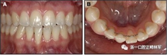 正畸文献阅读--固定舌侧保持器作用下意外的牙齿移动