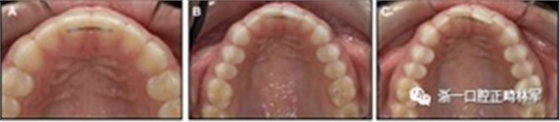 正畸文献阅读--固定舌侧保持器作用下意外的牙齿移动