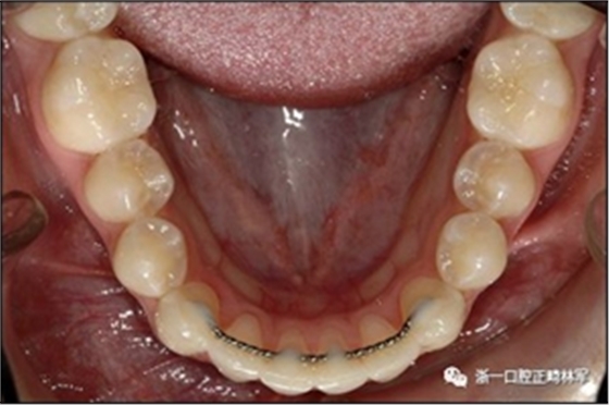 正畸文献阅读--固定舌侧保持器作用下意外的牙齿移动