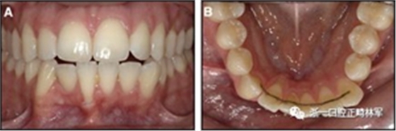 正畸文献阅读--固定舌侧保持器作用下意外的牙齿移动