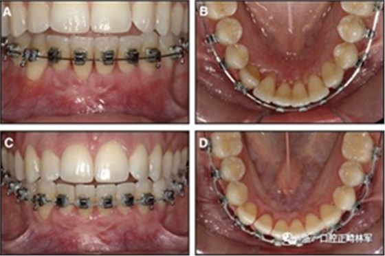 正畸文献阅读--固定舌侧保持器作用下意外的牙齿移动