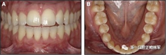 正畸文献阅读--固定舌侧保持器作用下意外的牙齿移动