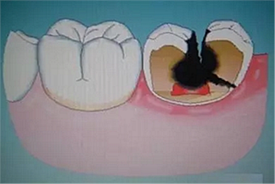 牙疼、磕掉牙、口长疱……这些急救知识你知道吗？