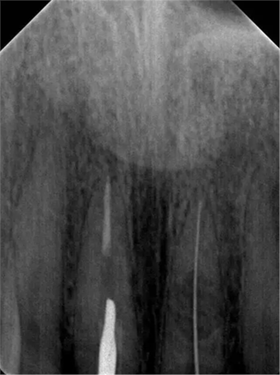 伴随根管内钙化物形成牙根内吸收治疗1例