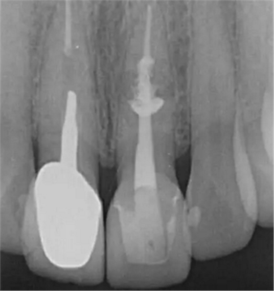 伴随根管内钙化物形成牙根内吸收治疗1例