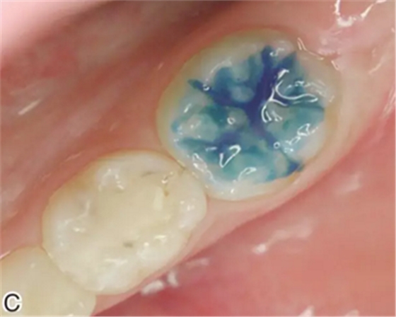 预防龋齿，口腔医生能帮我做什么？局部用氟、窝沟封闭、预防性树脂充填都是什么？