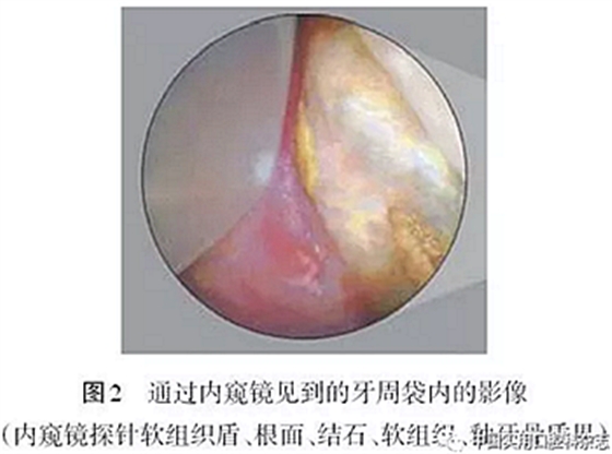 专题笔谈 | 内窥镜在牙周诊疗中的应用进展