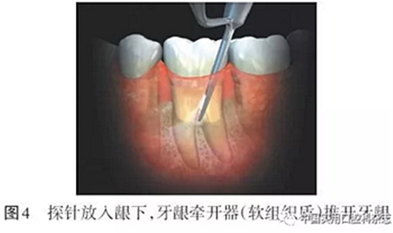专题笔谈 | 内窥镜在牙周诊疗中的应用进展