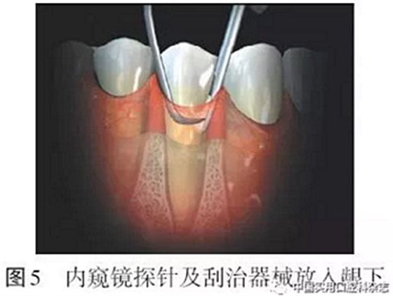 专题笔谈 | 内窥镜在牙周诊疗中的应用进展