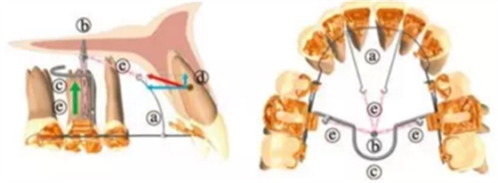 正畸文献赏析--舌侧矫治器的临床应用