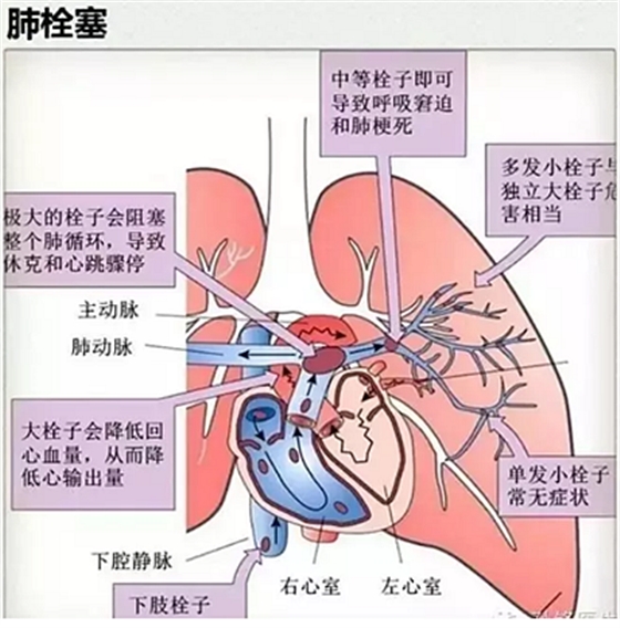 牙医要注意！3％双氧水口腔内冲洗致气体栓塞