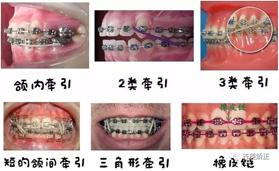 牙齿矫正，为什么要挂橡皮筋？