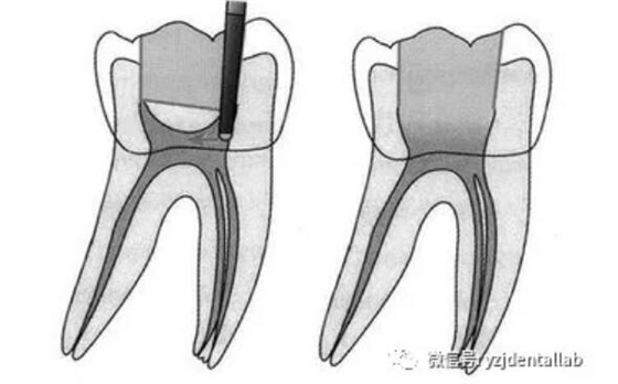 根管治疗