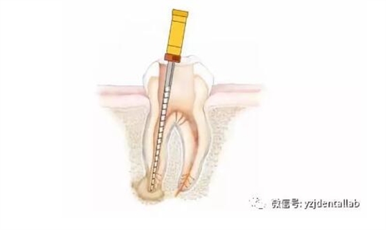 根管治疗