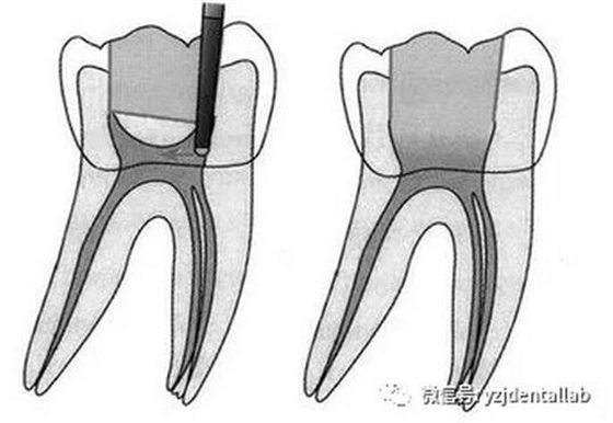 根管治疗
