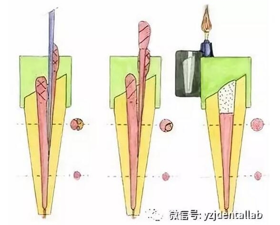 根管治疗