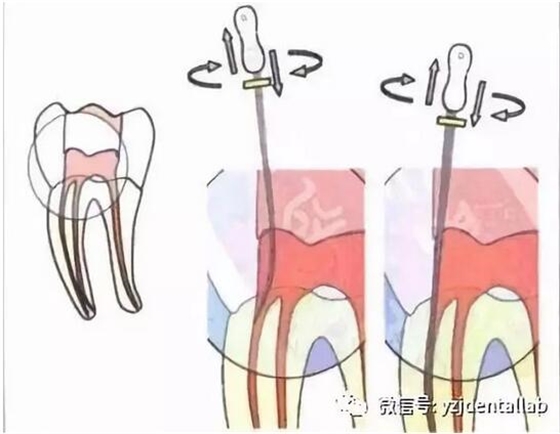 根管治疗