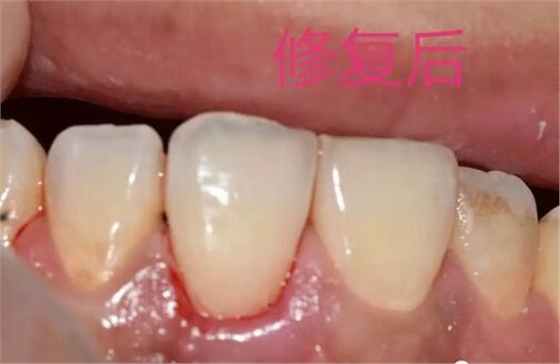 什么是牙齿楔缺？