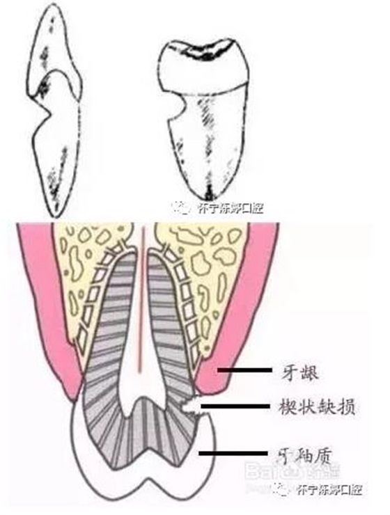 什么是牙齿楔缺？