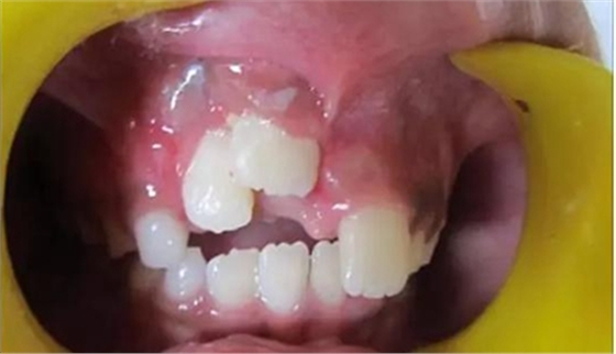 文献综述｜年轻恒牙挫入脱位的多学科治疗