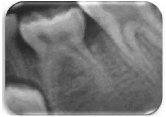 文献直达｜一项西班牙的研究：低位乳磨牙的发生频率、程度、牙根吸收和前磨牙发育不全情况