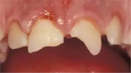 临床实践｜乳牙外伤处理指引（值得儿牙医生收藏）