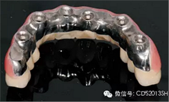 【经验分享】无牙颌种植修复固位的并发症与处理——宋应亮教授