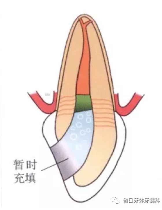 上前牙根管再治疗后内漂白1例