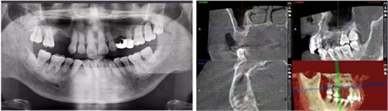 病例赏析 | 上颌窦外提升长期成骨观察