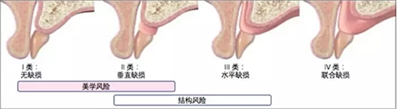 【文献精读】唇-齿-牙槽嵴分类：无牙颌上颌牙弓指南。诊断，风险评估及种植治疗指征