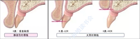 【文献精读】唇-齿-牙槽嵴分类：无牙颌上颌牙弓指南。诊断，风险评估及种植治疗指征