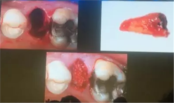 【听课笔记】拔牙后位点的软硬组织处理