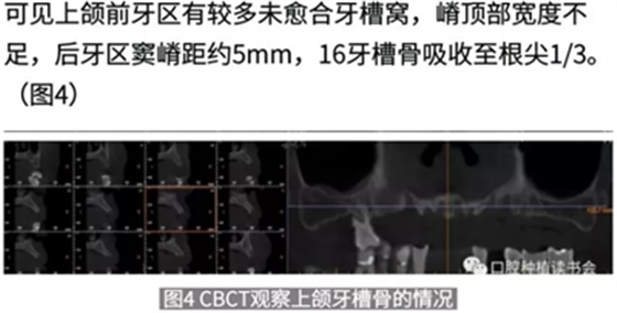 病例报道│全程数字化辅助无牙颌种植即刻负重