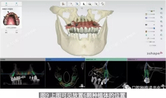 病例报道│全程数字化辅助无牙颌种植即刻负重