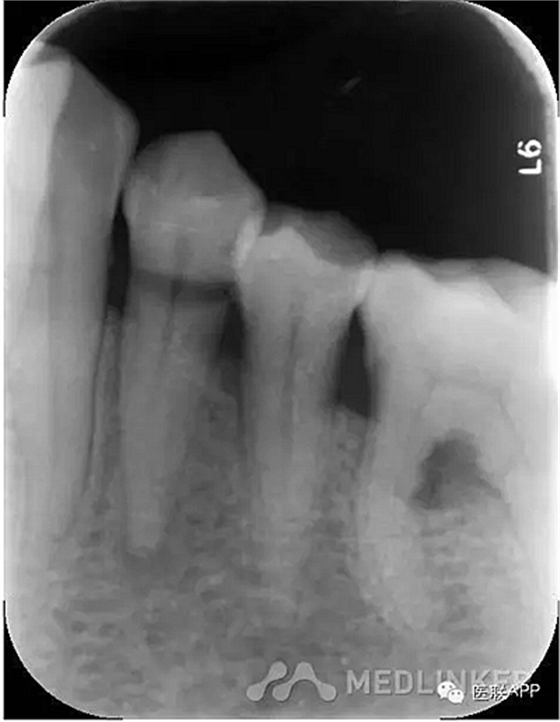 楔状缺损导致根尖周炎