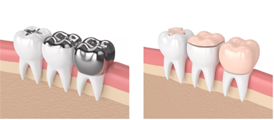 牙桩、牙冠、活动义齿修复材料，怎么选？