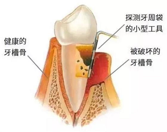 上海嘉福口腔研究所二十一世纪牙周病的临床进展