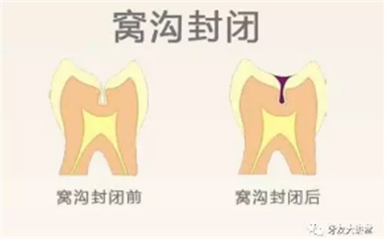 儿童防龋齿【窝沟封闭】和【涂氟】是一回事儿吗？