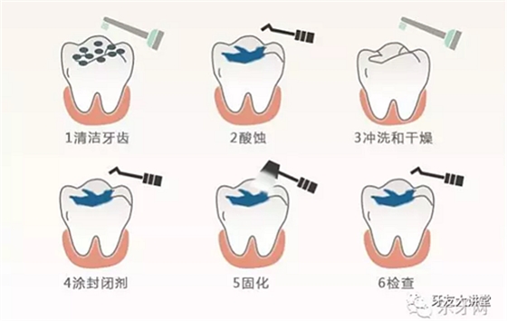 儿童防龋齿【窝沟封闭】和【涂氟】是一回事儿吗？