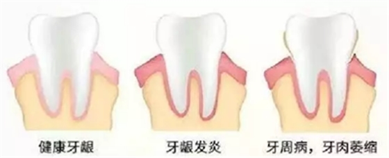 牙周炎，中国成年人后半生永远的 痛 ！